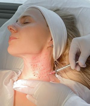 Wysokostężone Osocze Bogatopłytkowe HD PRP Angel System PREMIUM